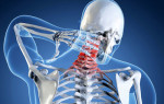Как проявляется остеохондроз шейного отдела: причины и лечение