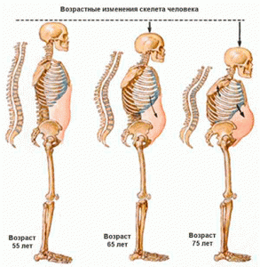 стадии развития остеопороза